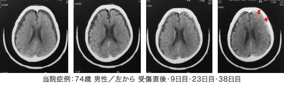 慢性硬膜下血腫